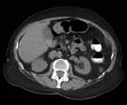 CT gallstones image