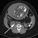 CT ureter kidney stone image