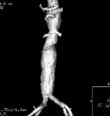 CT angiography image