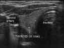 Thyroid ultrasound image