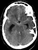 CT image