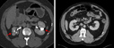 Kidney (Renal) Failure image