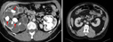 Kidney (Renal) Failure image