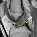 A tear of the anterior cruciate ligament of the knee.