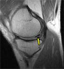 A horizontal tear of the posterior part of the meniscus