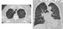 CT of lungs showing emphysema