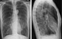 X-ray of lungs showing emphysema