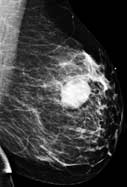 Digital mammogram image