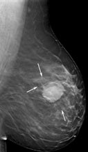 Breast tomosynthesis image