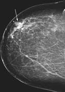 Digital mammogram image