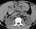 multi-detector CT kidney stone image