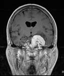 Meningioma centered in the left mid skull base.