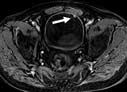 Bladder MRI image