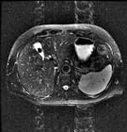 MRI abdomen gallstones image