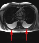 Chest MRI image