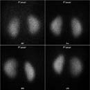 Four renal scintigraphy images