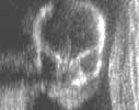 Ultrasound image