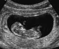 Ultrasound image