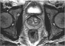 Prostate MRI image