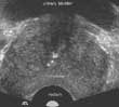 ultrasound prostate image