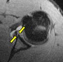 MRI of a shoulder showing anterior-labrum