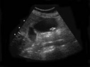 ultrasound gallstone image