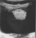 Transverse ultrasound image