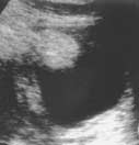 Sagittal ultrasound image