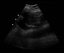 ultrasound kidney stone image