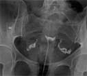 Hysterosalpingography image