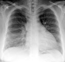 chest x-ray image