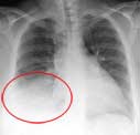 chest x-ray image