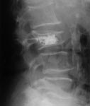 Lumbar spine x-ray image