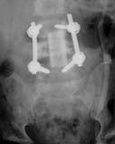 Lumbar spine x-ray image