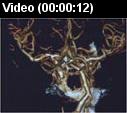 CT angiography of the brain video