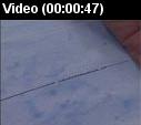 Carotid stenting video