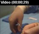 Catheter embolization video